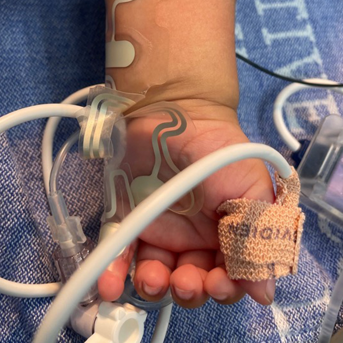 Babys hand med medicinska sensorer, droppslang och ett förband, som vilar på ett blått sjukhustäcke.
